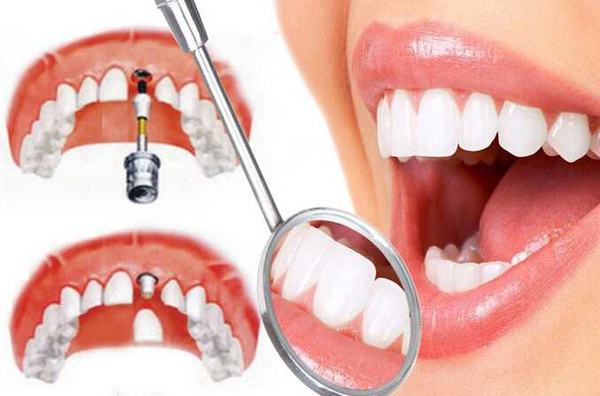 肥西牙齿缺损可以选择种植牙修复吗？