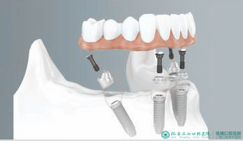 肥西牙齿缺失的修复方法？