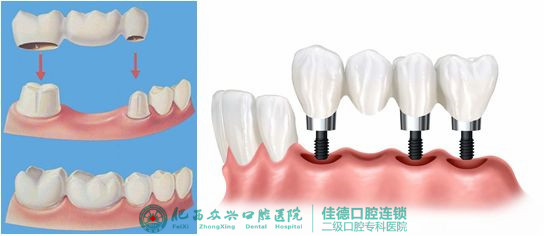 肥西牙科医院种植牙系统有哪些？