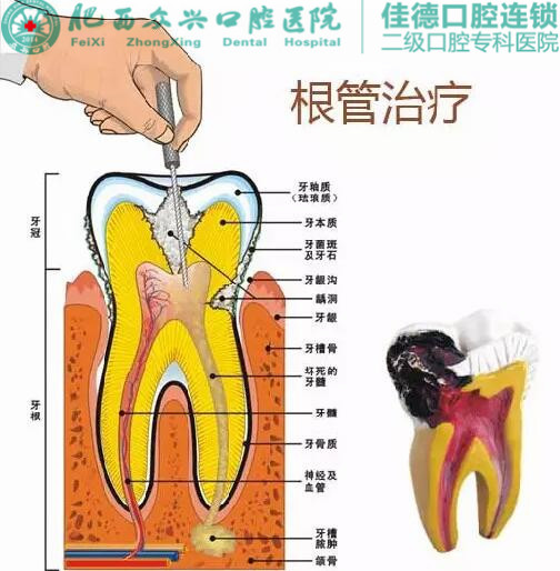 肥西佳德众兴口腔医生介绍什么是根管的治疗？