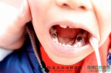 肥西儿童蛀了牙什么治疗措施好？