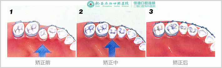 肥西矫正牙齿哪个医院好？