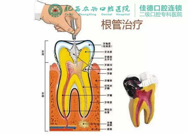 补牙需要做根管的治疗吗？
