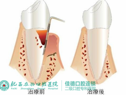 根管的治疗可以治疗哪些牙齿疾病？