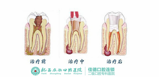 牙齿疼要做根管的治疗吗？