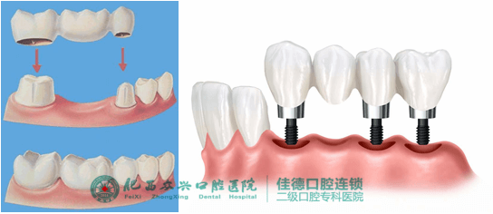 牙齿缺失烤瓷牙和种植牙哪个修复好？
