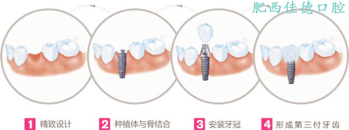 种植牙过程分为几个步骤
