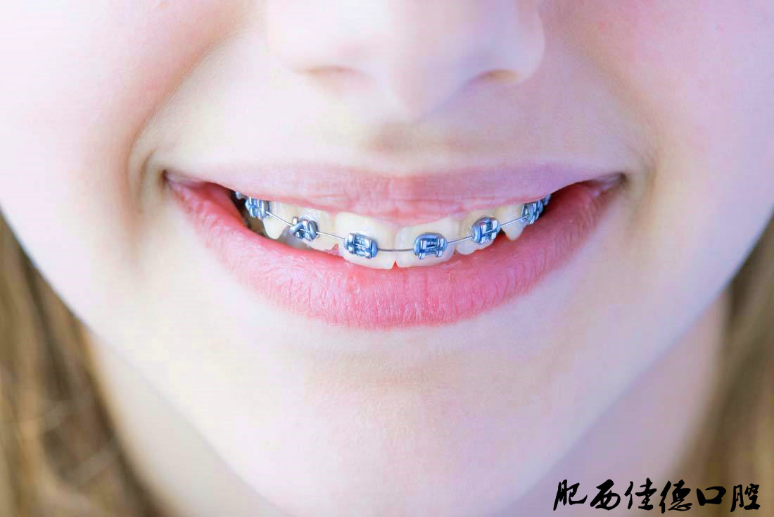 牙套种类有哪些?