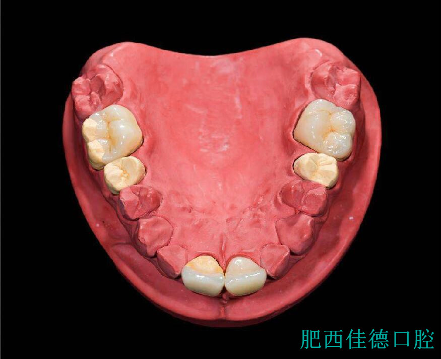 肥西口腔医院镶牙价格