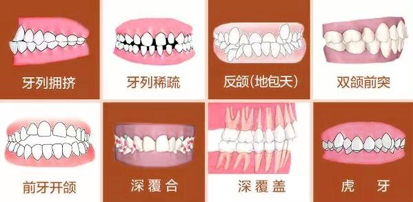 常见牙齿畸形问题