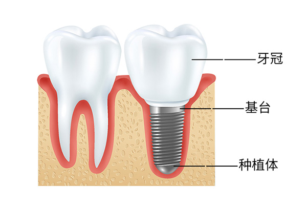 种植牙