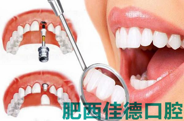 种植牙能用多久？