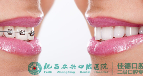 牙齿缝隙大该怎么办啊？