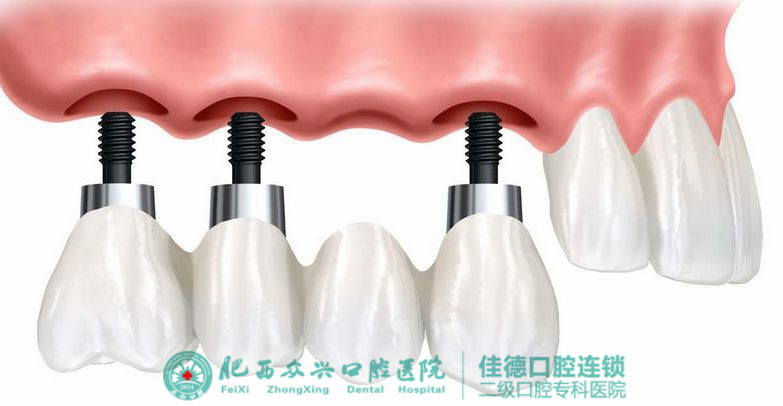 牙齿缺失去肥西口腔医院做什么修复好？