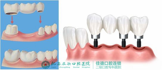 肥西种一颗牙齿费用要多少？