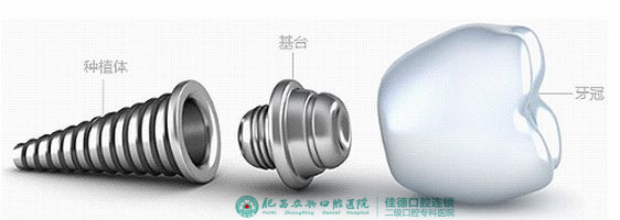 牙齿掉了多久可以做种植牙？
