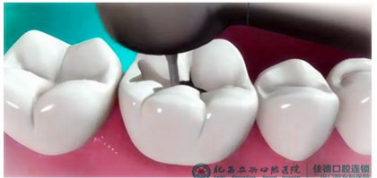 做窝沟封闭可以预防蛀了牙吗？