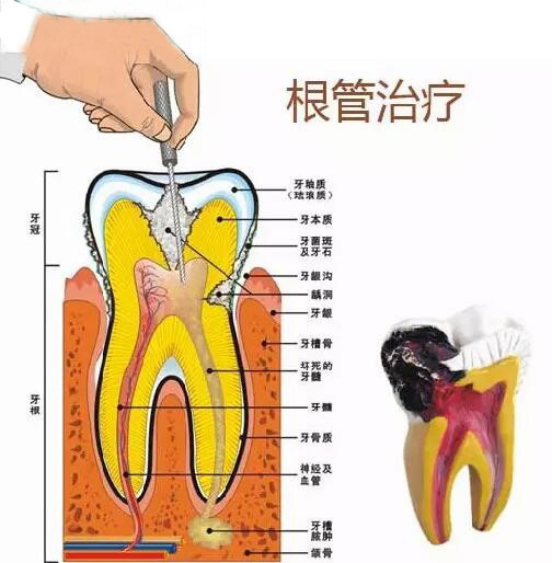 肥西做根管的治疗的价格贵吗？