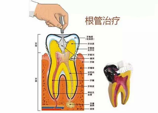 补牙需要做根管的治疗吗？