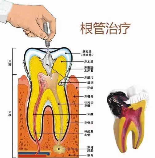 根管的治疗需要注意些什么？