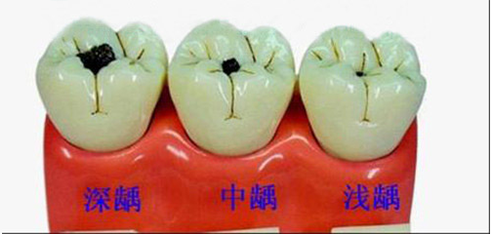 牙齿上面有黑点是怎么回事？