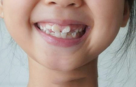 肥西小孩子牙齿矫正戴牙套多少钱？