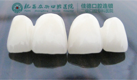 在肥西佳德镶烤瓷牙多少钱？