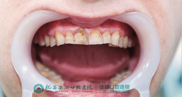 氟斑色牙的危害有哪些？