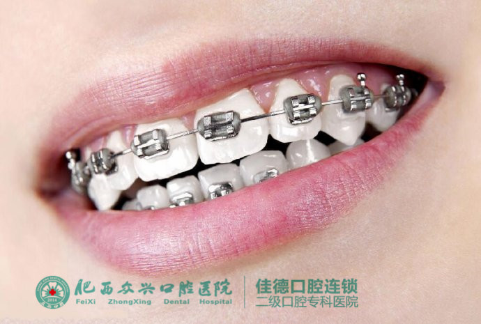 肥西牙齿稀疏可以矫正吗？