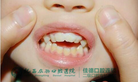 小孩在肥西牙科医院做矫正便宜吗？