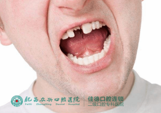 肥西门牙掉了该怎么办？
