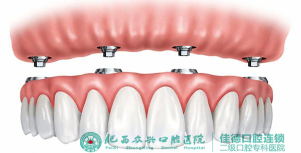 牙齿掉了选择哪种修复方式好？