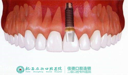 在肥西县的口腔医院种一颗牙多少钱？