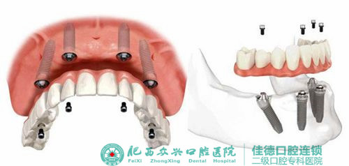 肥西种牙价钱多少啊？