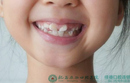 肥西儿童牙齿矫正的价格？