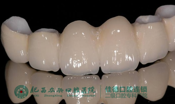 烤瓷牙的寿命有多长？