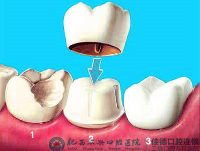 肥西烤瓷牙多少钱一颗