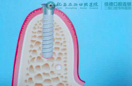 后牙缺失怎么办