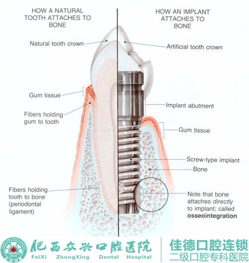 门牙种植牙一颗多少钱