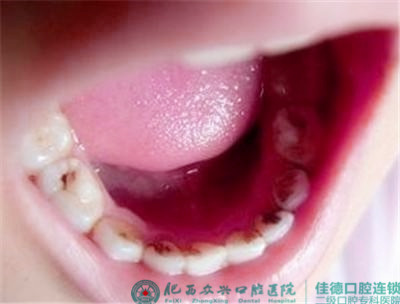 如何预防儿童龋坏