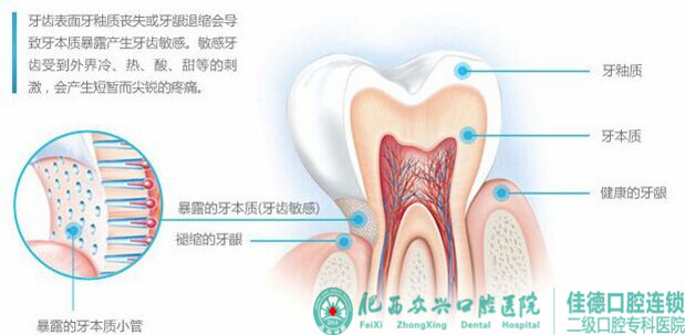 洗牙前做牙齿脱敏治疗