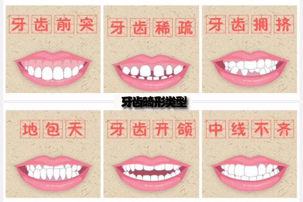合肥牙齿畸形矫正