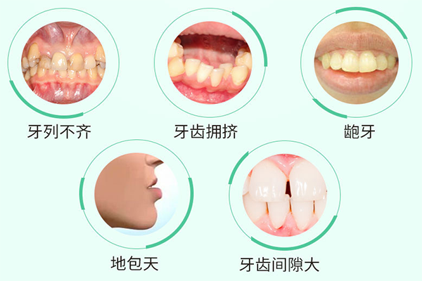 畸形牙